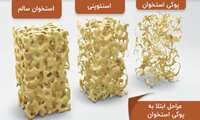 واقعیاتی در مورد استئوپروز                                                                                                                                 