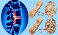 29 مهرماه روز جهانی پوکی استخوان